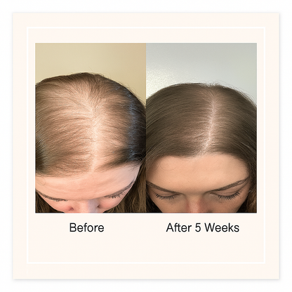 RollBack Roots™ | Hair Regrowth Roller