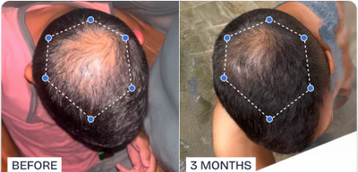 Phyne™ | Hair Growth Roll-On Serum