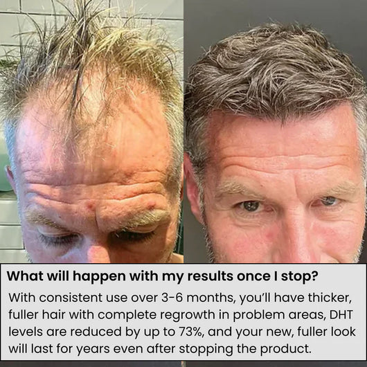 Phyne | Hair Regrowth System